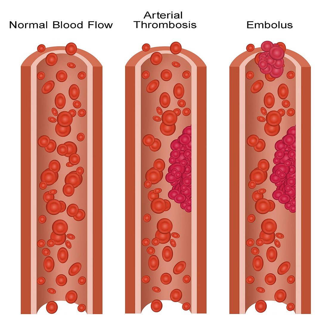 Blood Clots,Illustration