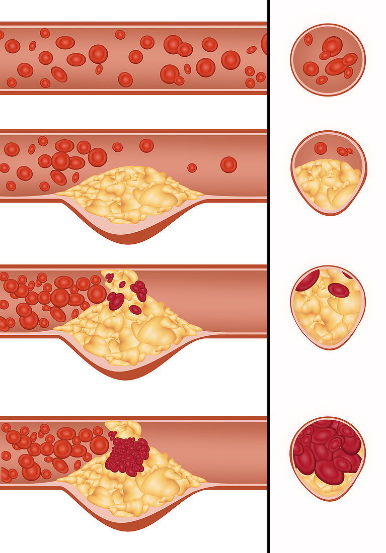 Plaque in Artery,Illustration
