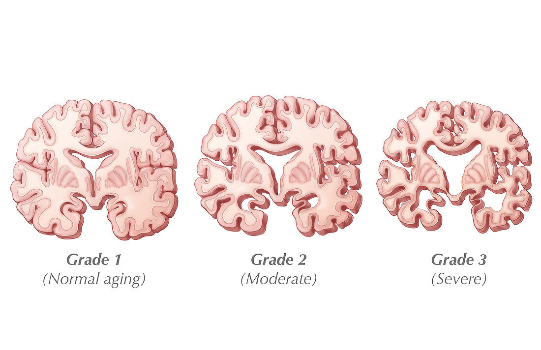 Alzheimer's Progression,Illustration