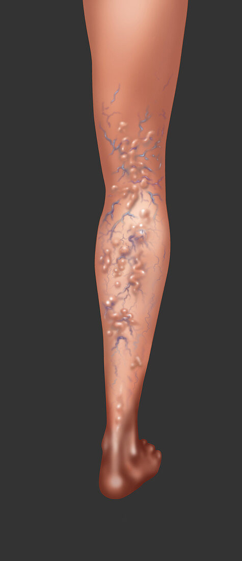 Varicose veins,Illustration