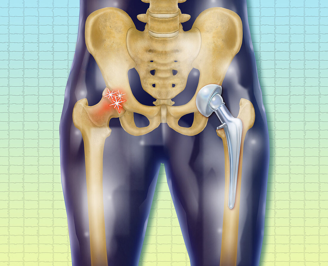 Replacement Hip,Illustration