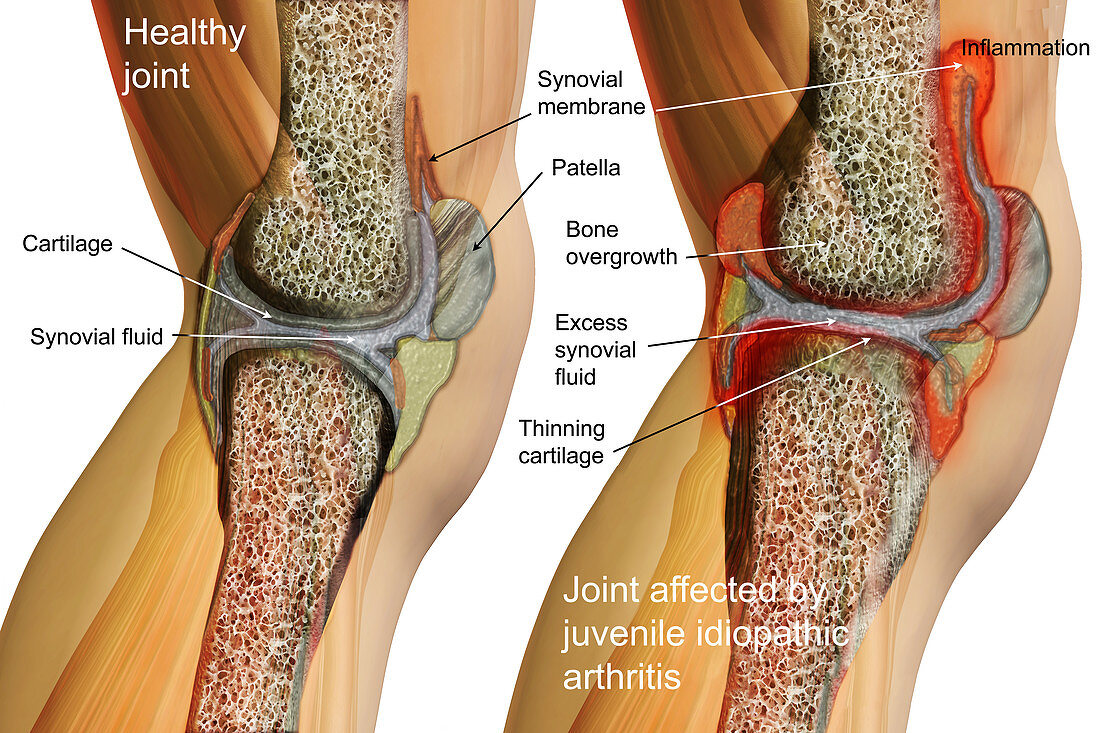 Systemic Juvenile Arthritis,Illustration