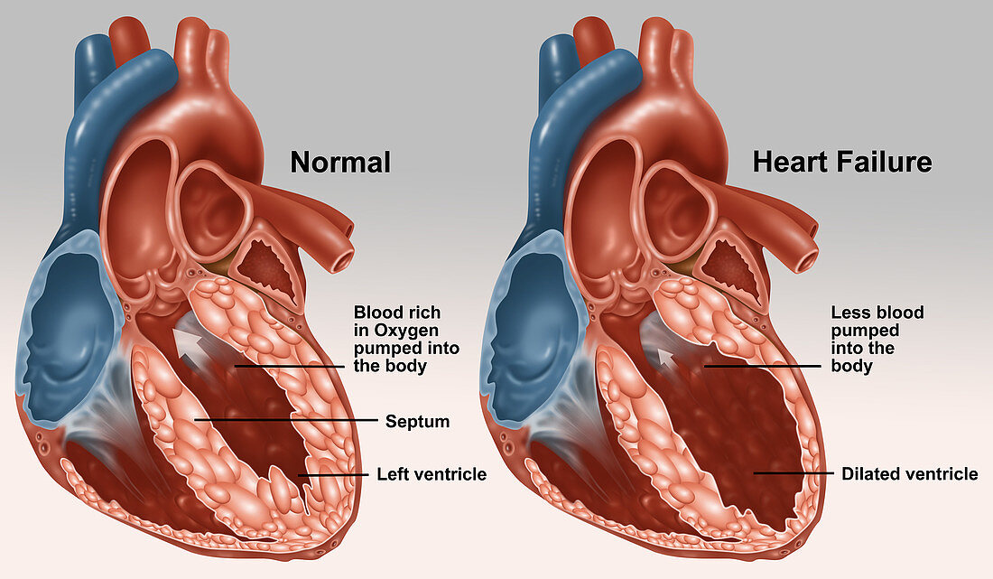 Normal and Diseased Hearts,Illustration