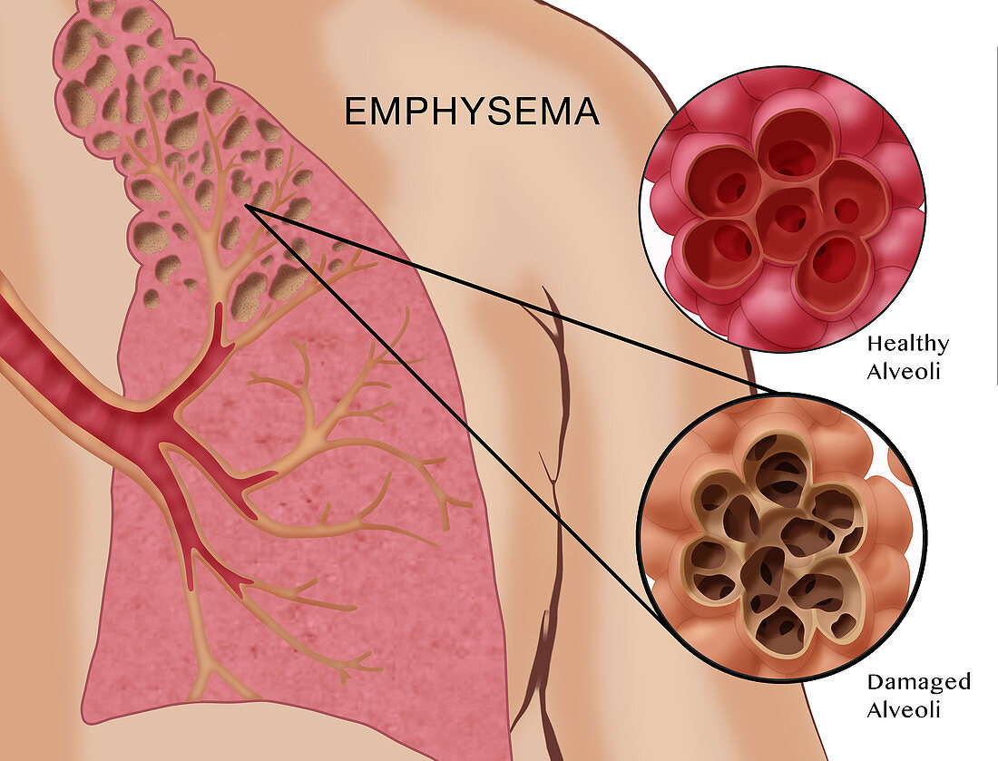 Emphysema,Illustration