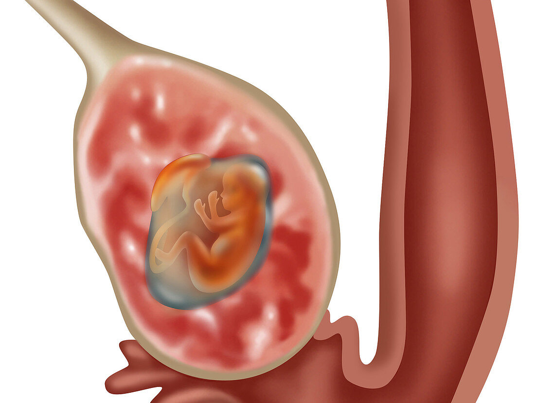 Ovarian Pregnancy,Illustration