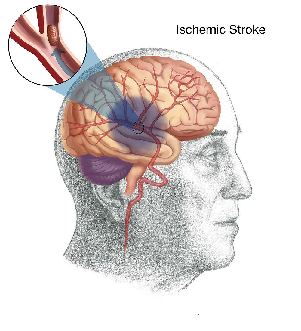 Ischemic Stroke,Illustration