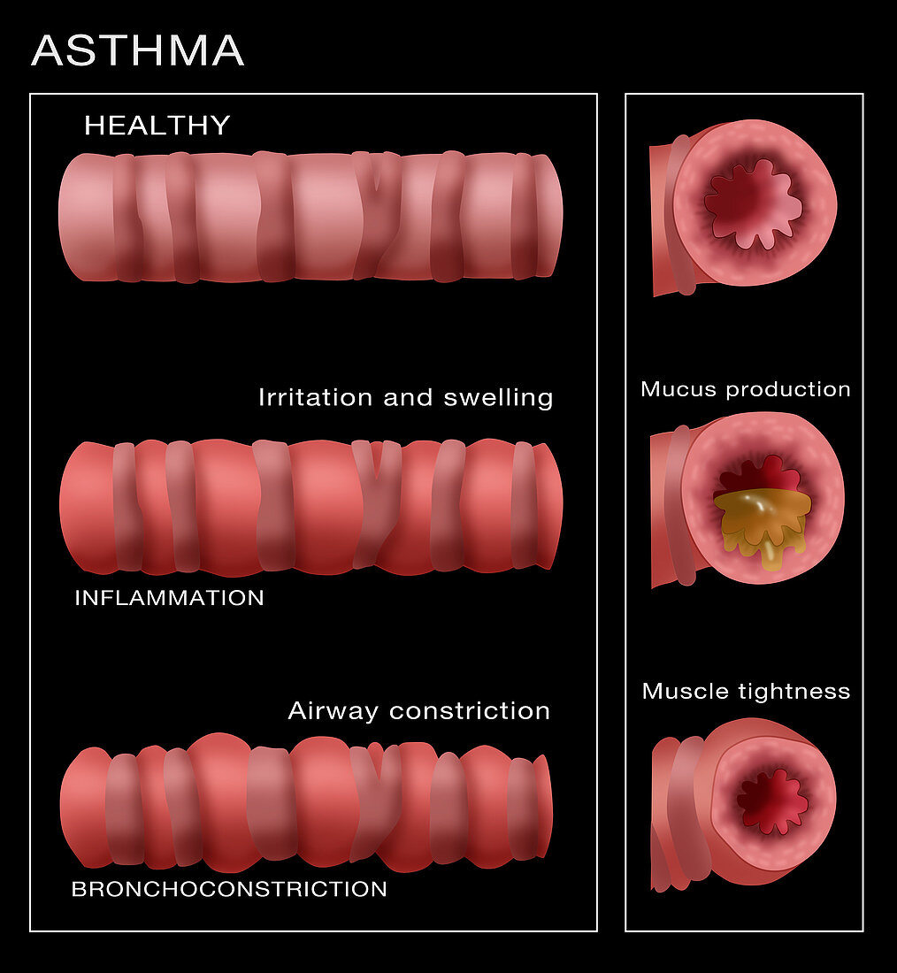 Bronchoconstriction,Asthma,Illustration