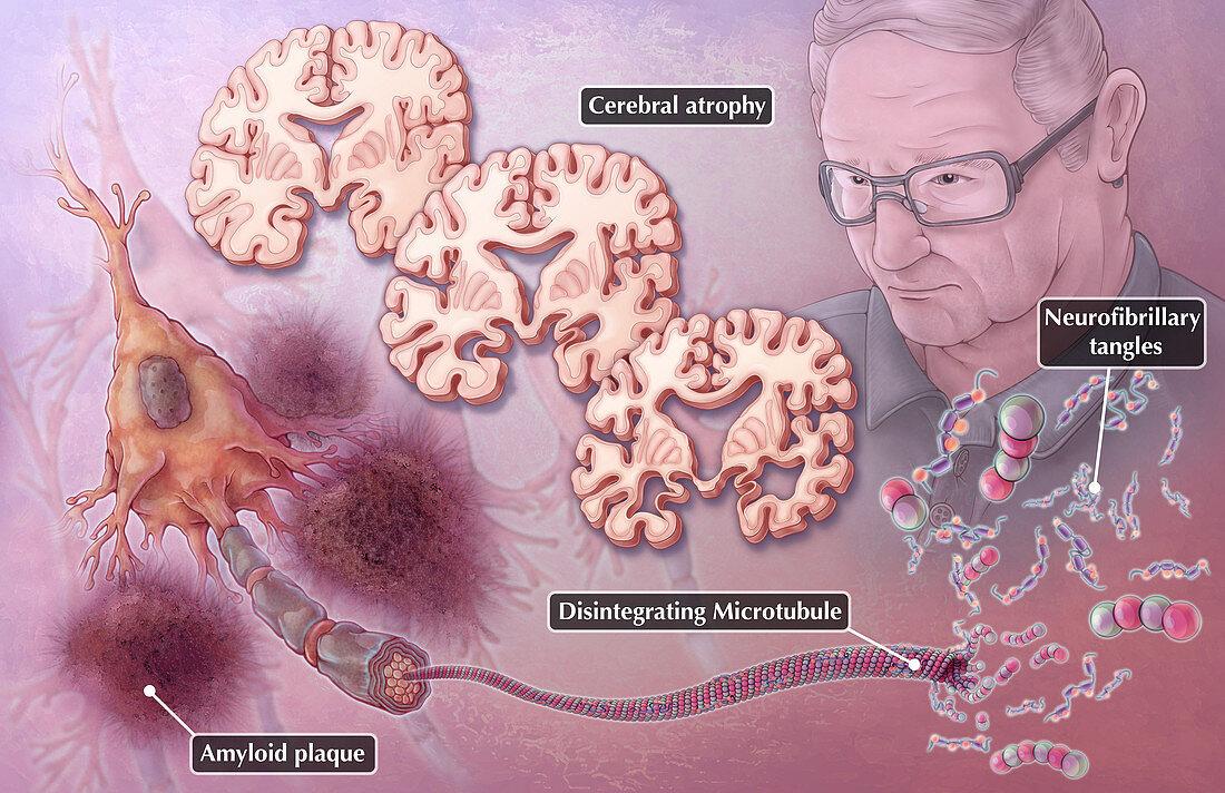 Alzheimer's Neuropathology,Illustration