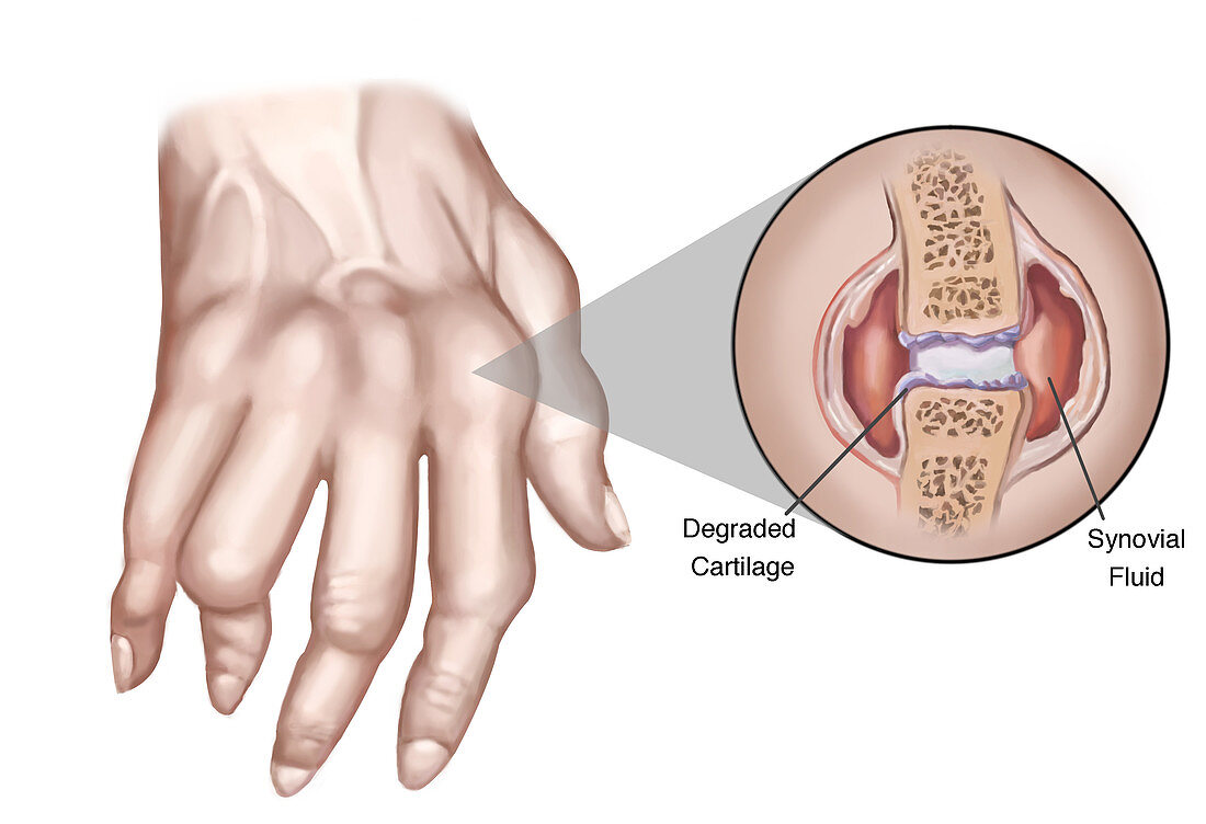 Rheumatoid Arthritis,Illustration