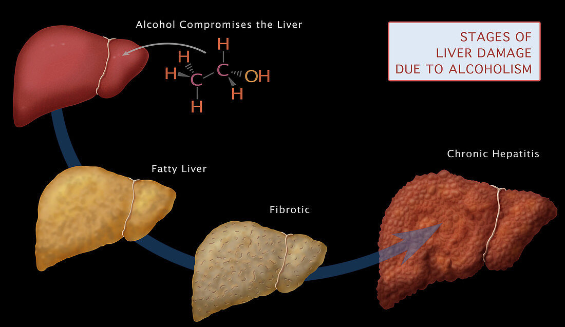Stages of Liver Damage,Illustration