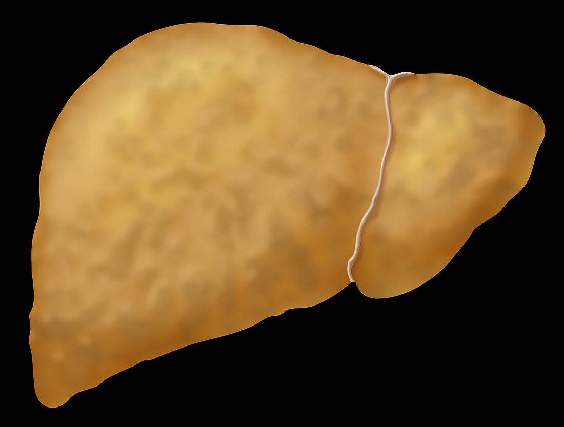 Fatty Liver Disease,Illustration
