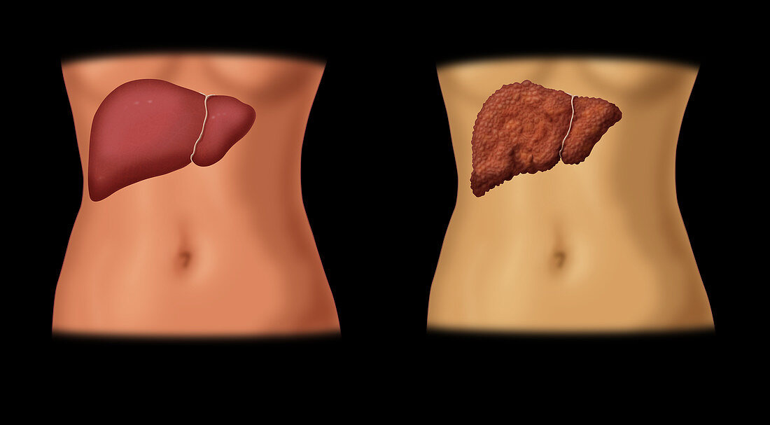 Healthy vs. Cirrhotic Liver,Illustration