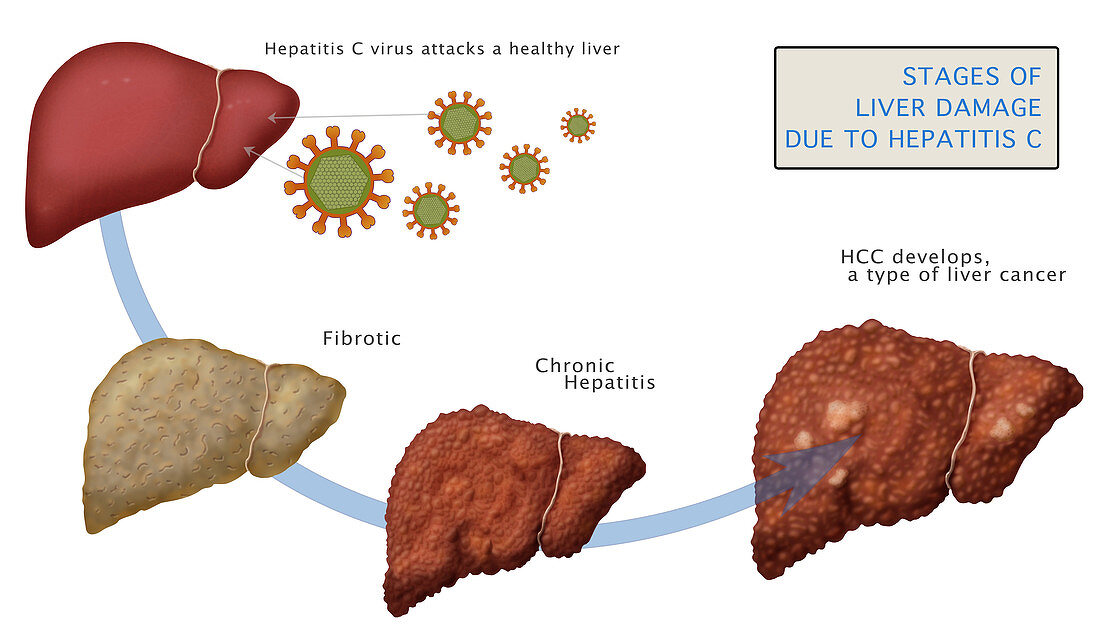 Liver Damage in Hepatitis C,Illustration