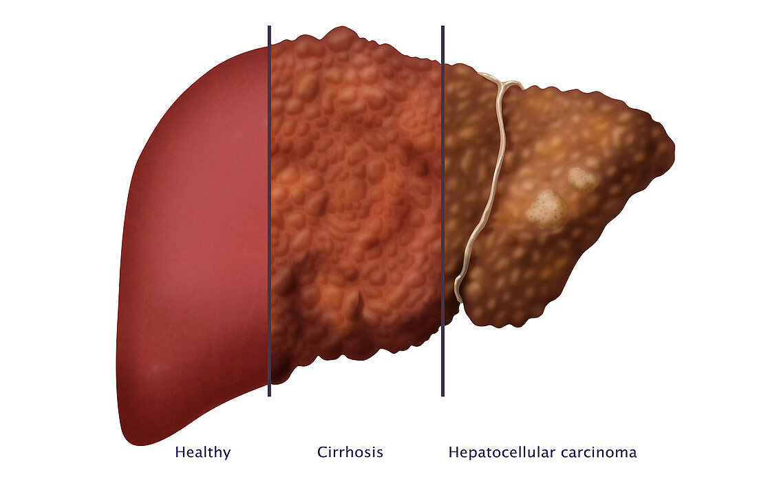 Liver Comparison,Illustration