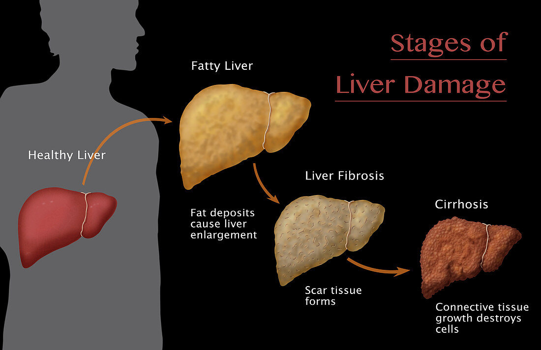 Stages of Liver Damage,Illustration