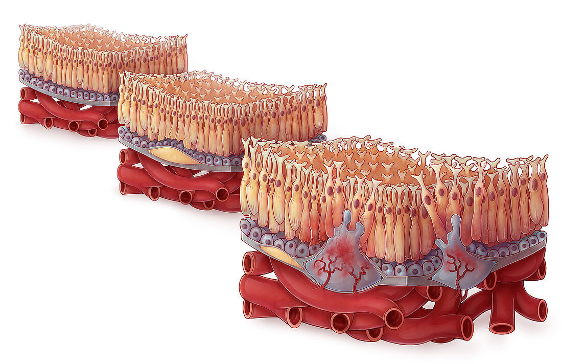 Macular Degeneration,Illustration