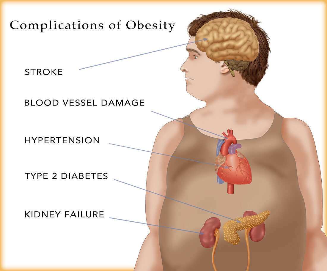Complications of Obesity,Illustration