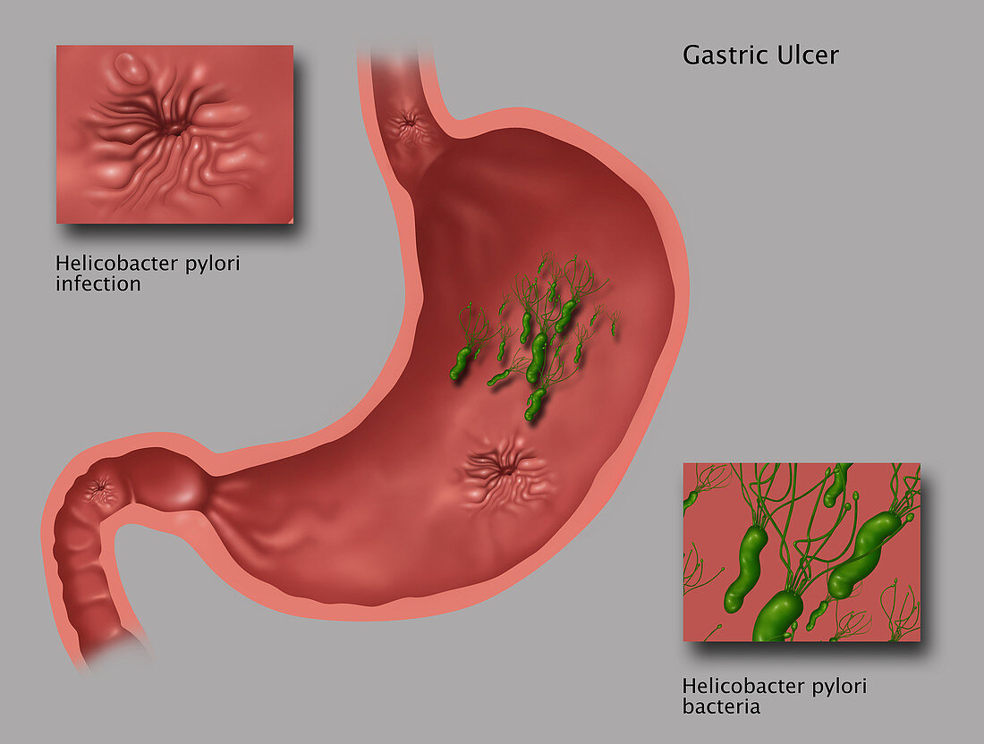 Helicobacter Pylori,Illustration