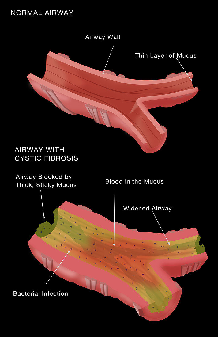 Cystic Fibrosis,Illustration
