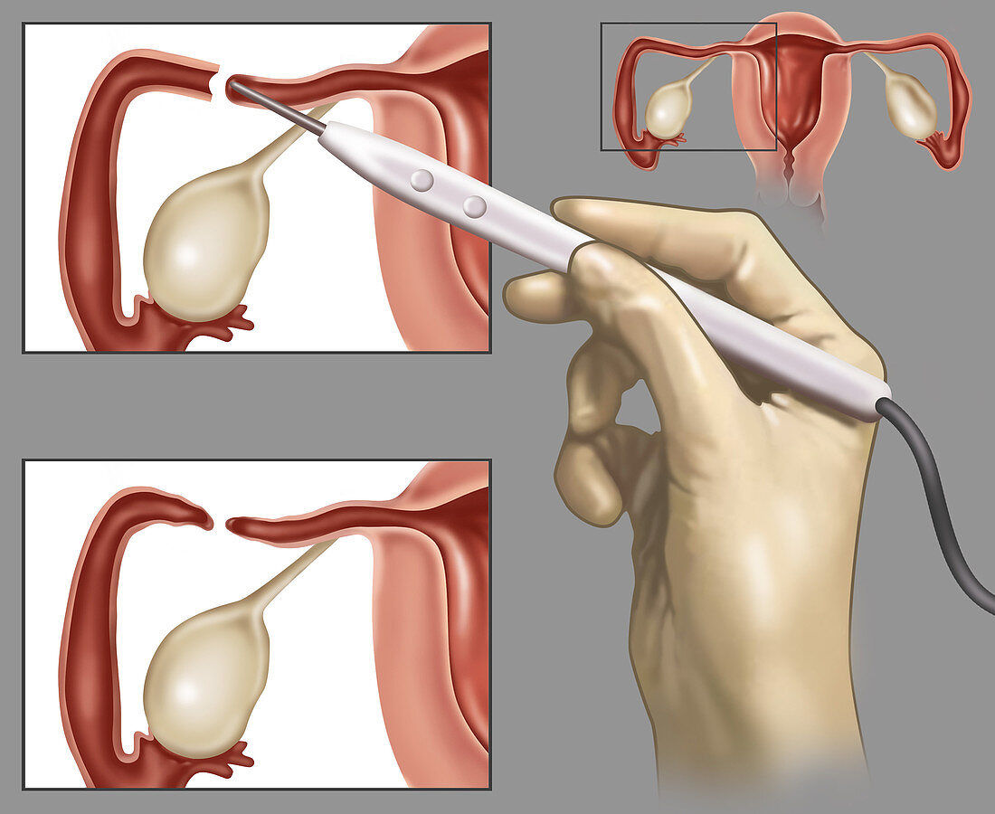 Fallopian Tubes cauterized,Illustration