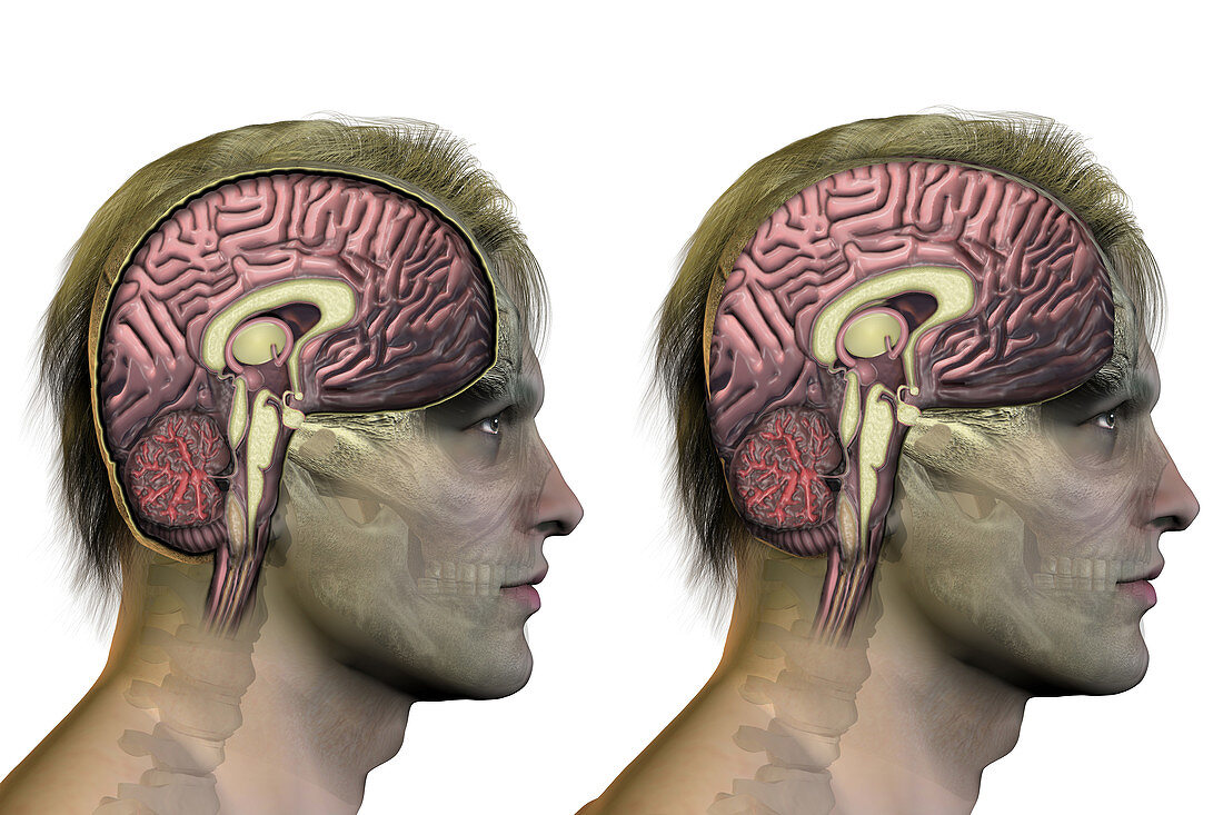 Brain,Hyponatremia,Illustration