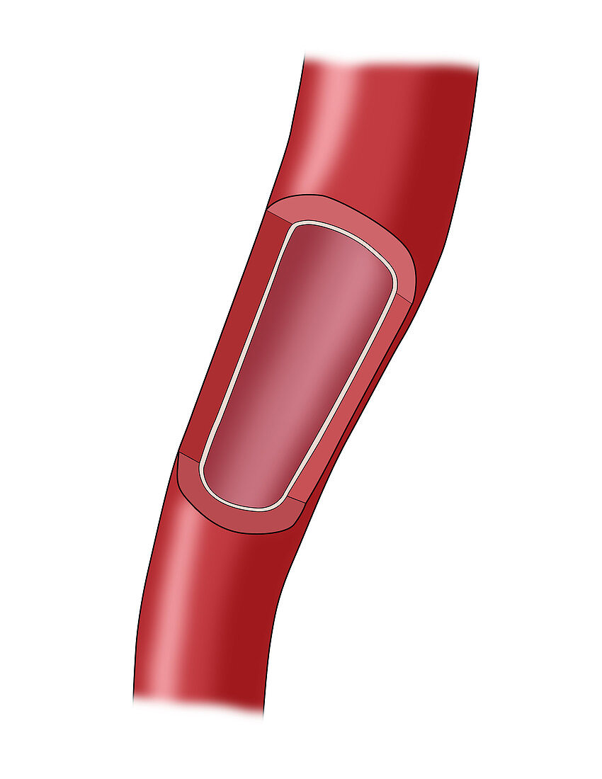 Clogged Artery,1 of 4,Illustration