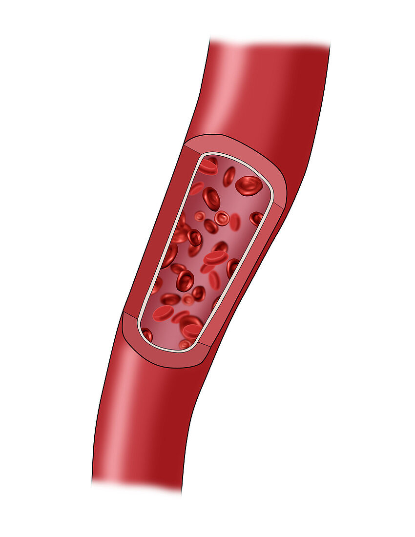 Clogged Artery,1 of 5,Illustration