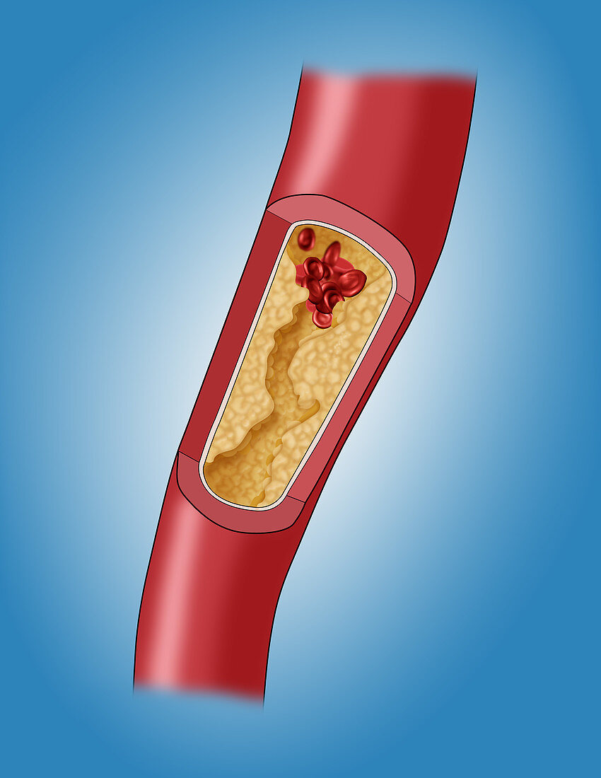 Clogged Artery,5 of 5,Illustration