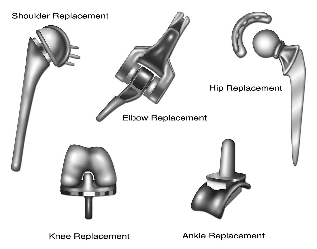 Joint Replacement,Illustration