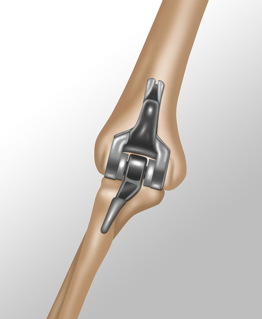 Elbow Joint Replacement,Illustration