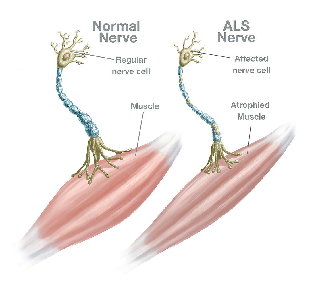 Normal Nerve and ALS Nerve,Illustration