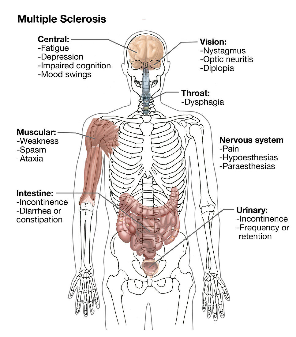Multiple Sclerosis Symptoms,Illustration