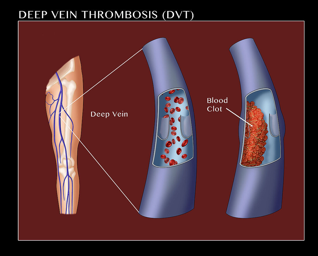 Deep Vein Thrombosis,Illustration