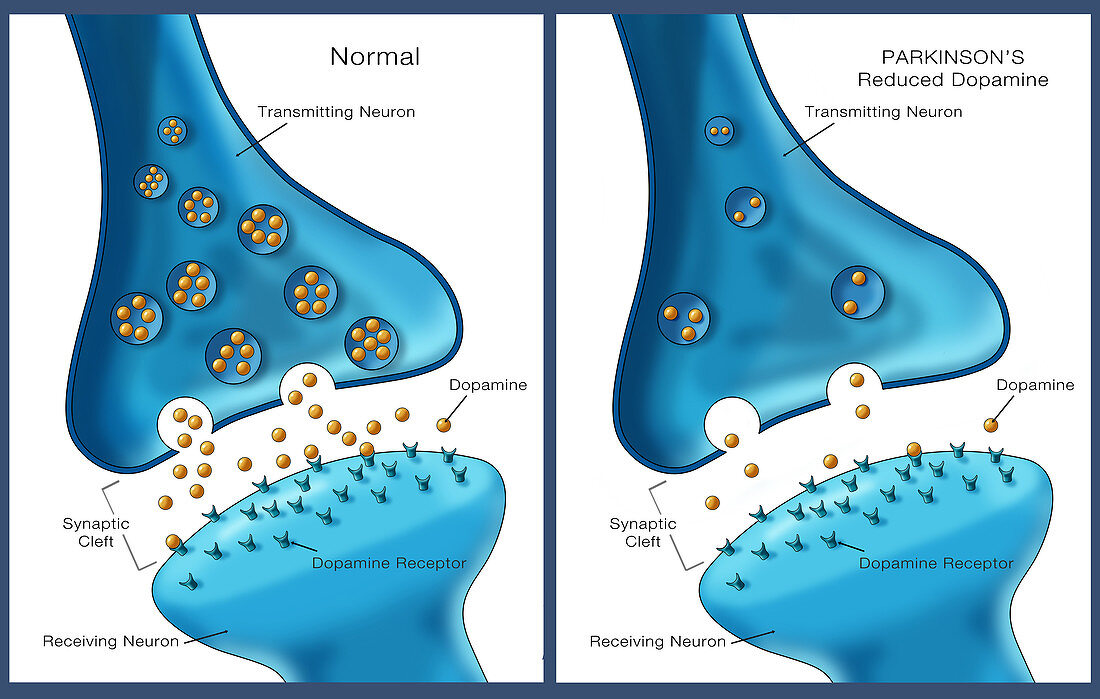 Parkinson's & Dopamine,Illustration