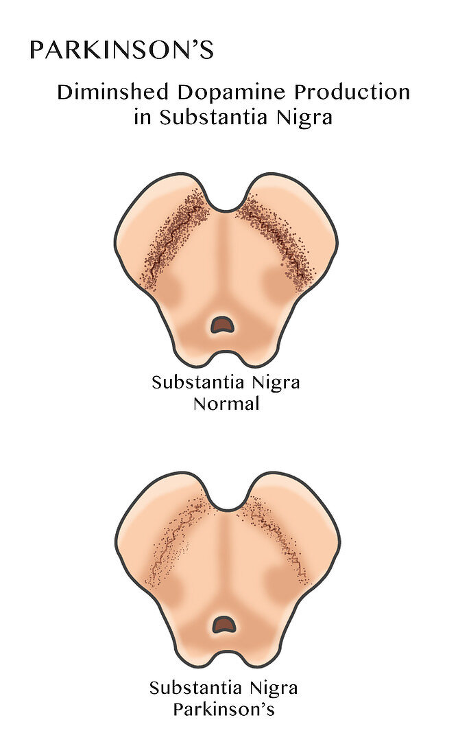 Parkinson Substantia Nigra,Illustration