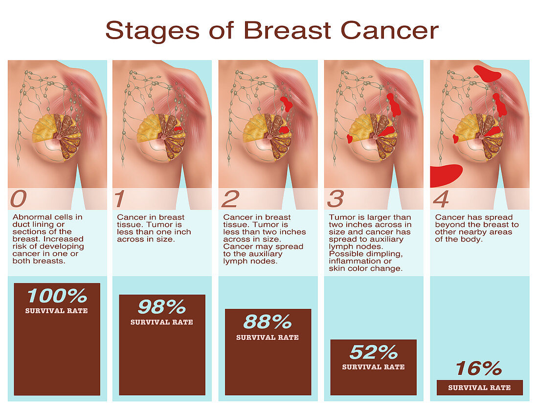 Breast Cancer Stages,Illustration