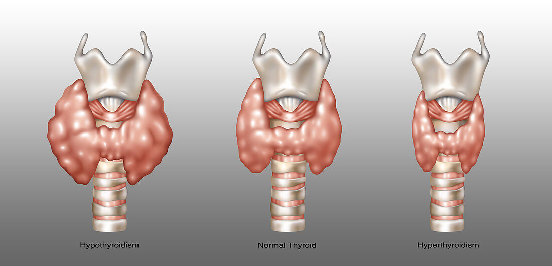 Thyroid Disorders,Illustration