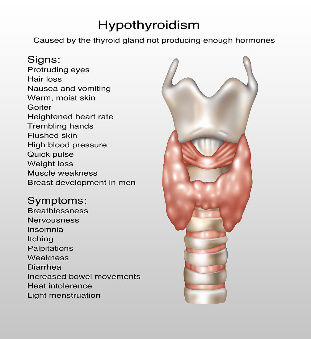 Hypothyroidism,Illustration