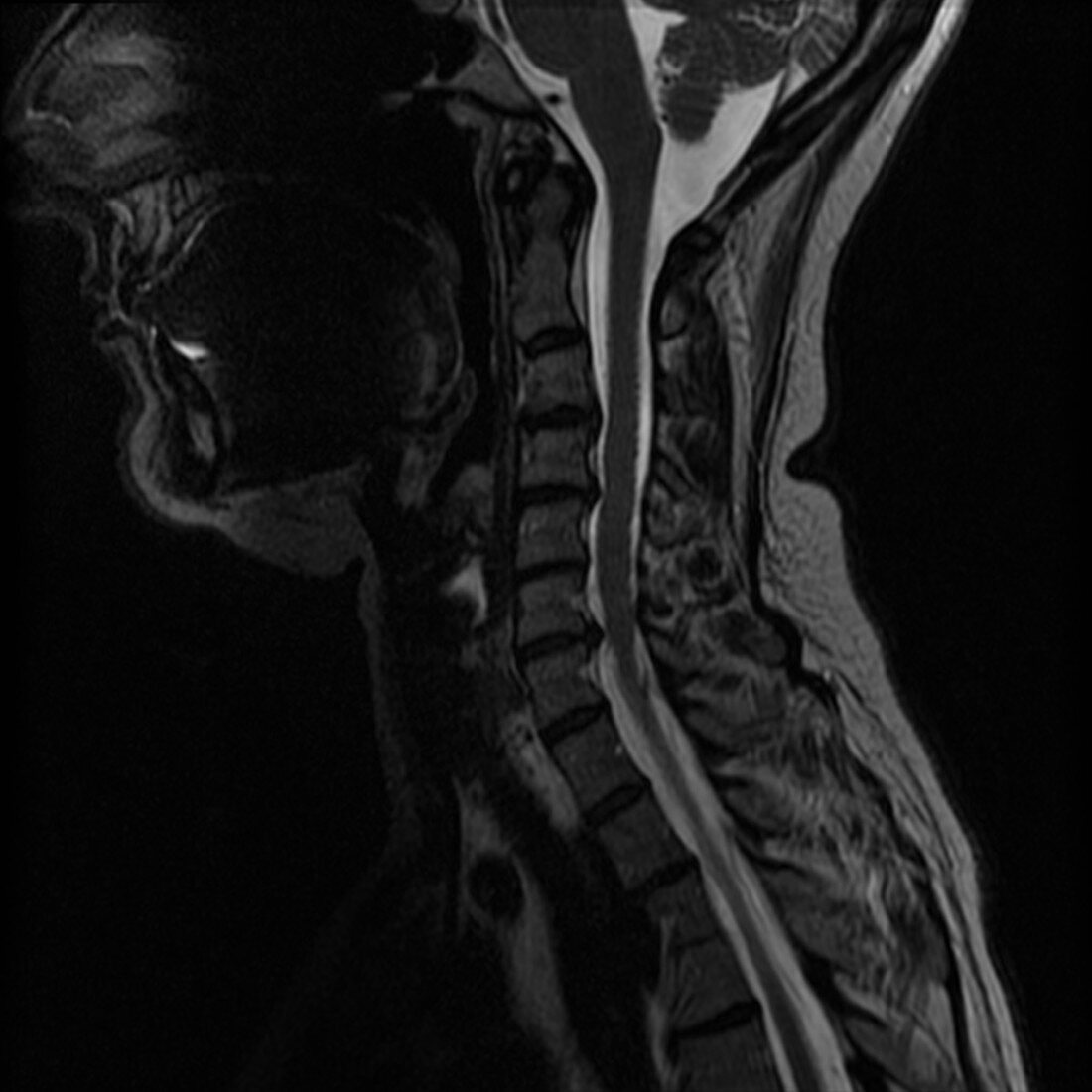 Cervical Spine Injury,MRI,Illustration