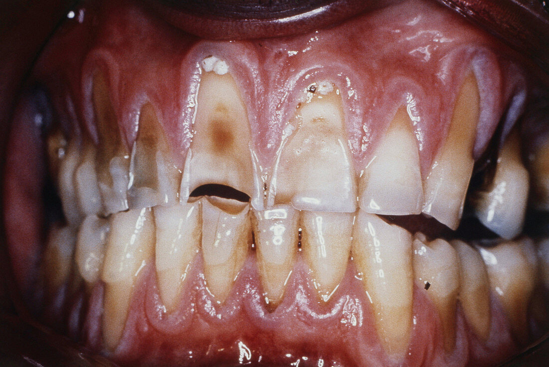 Sever Dental Erosion