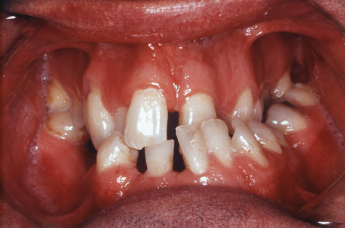 Abnormal Teeth Spacing