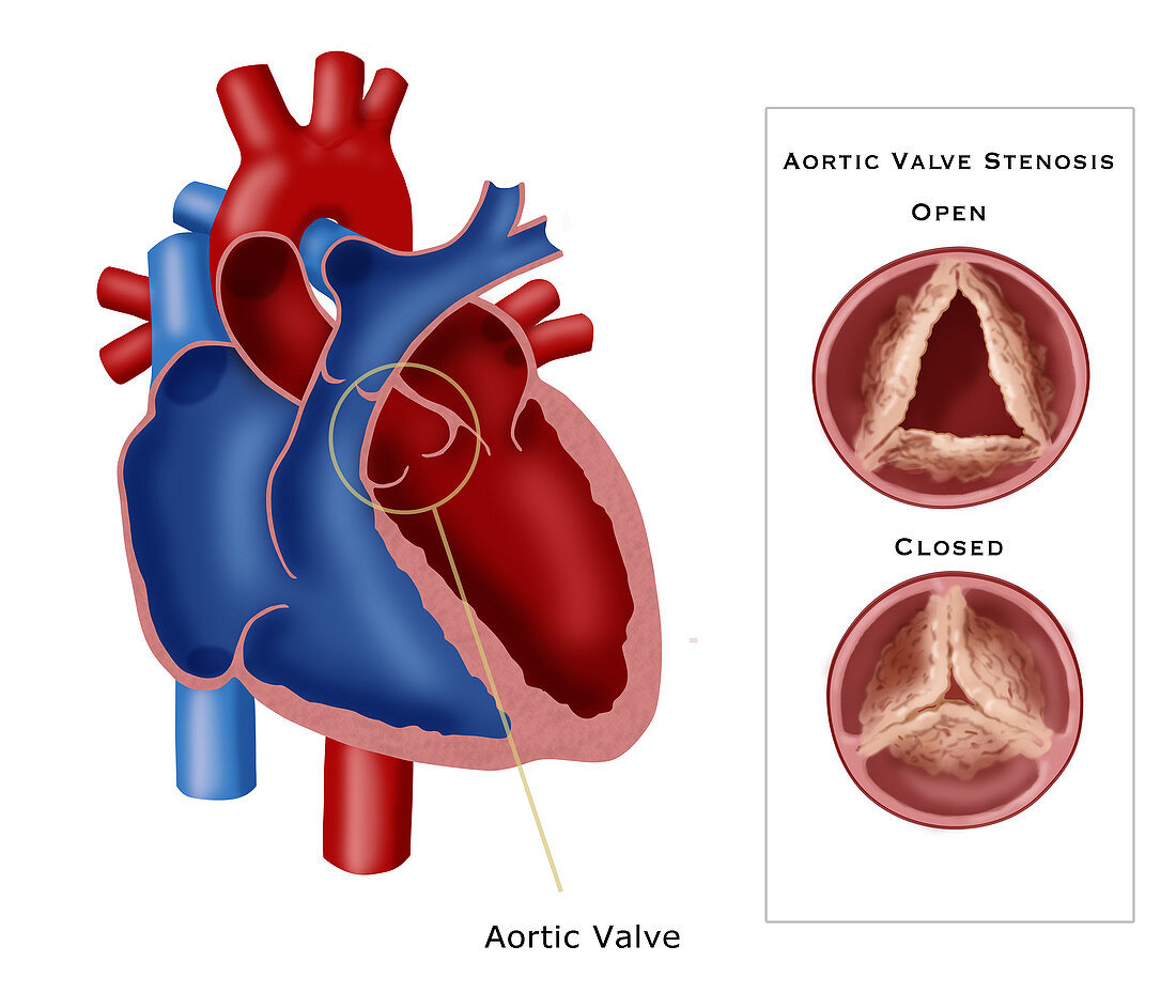 Aortic Valve Stenosis,illustration