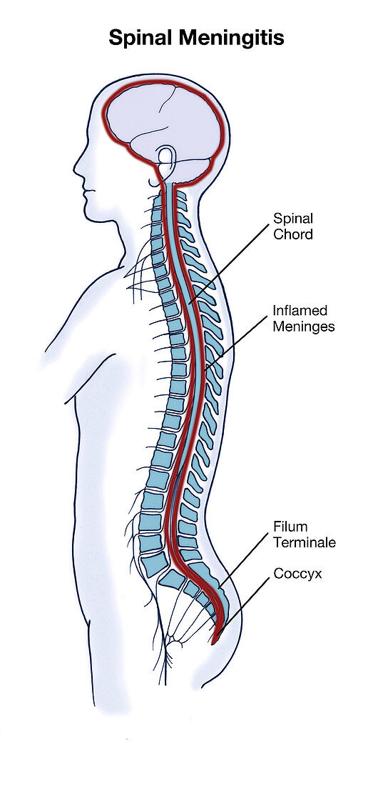Spinal Meningitis,illustration