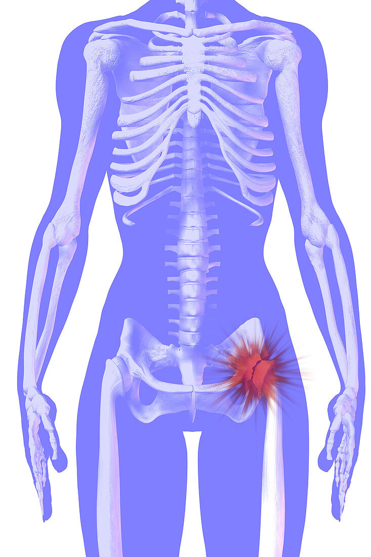 Hip Fracture,illustration