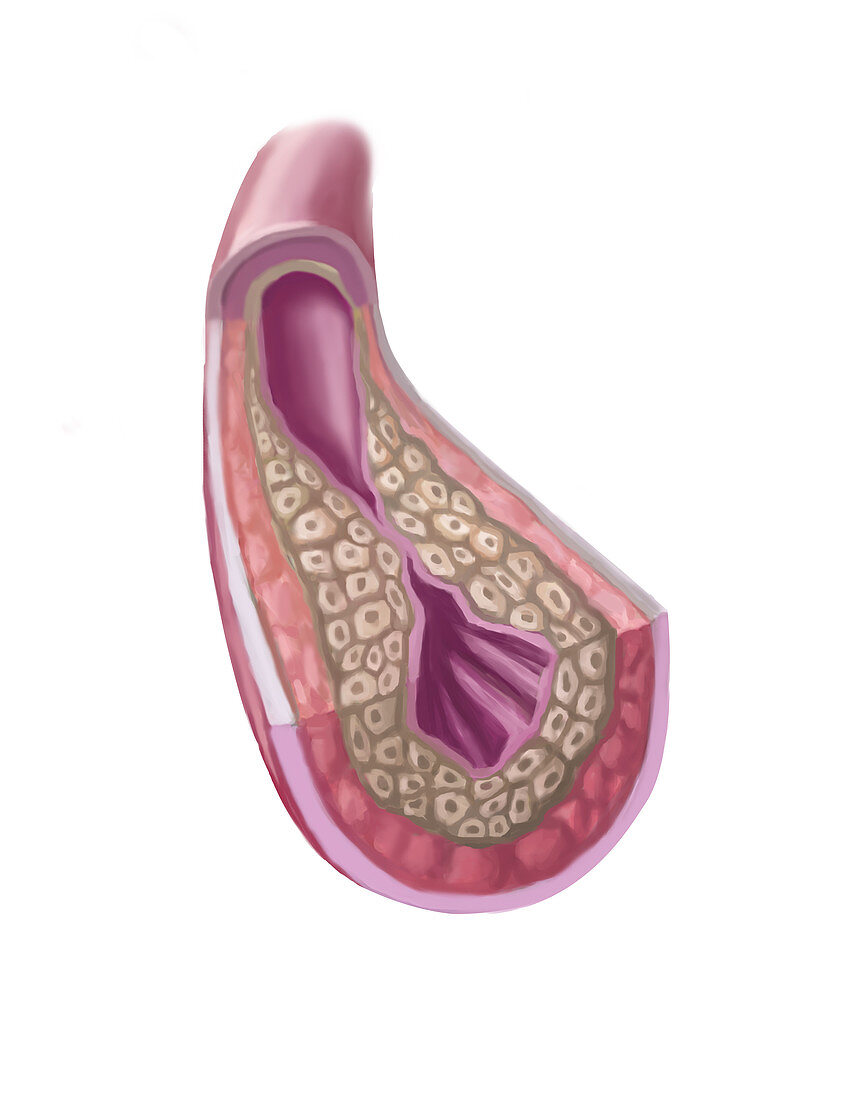 Clogged Artery,illustration