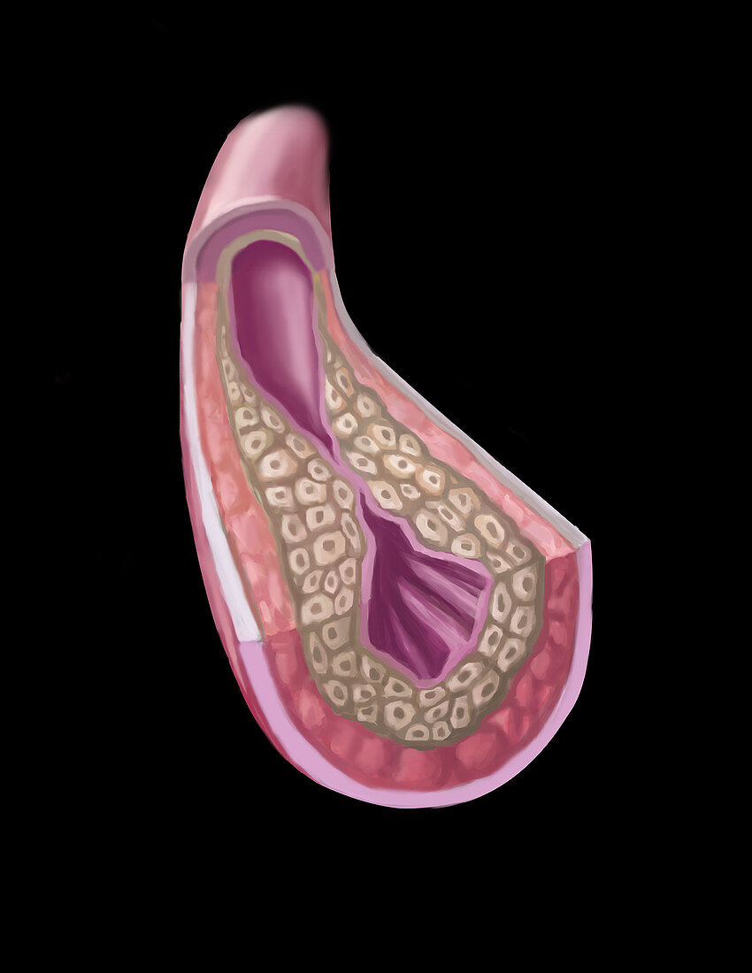 Clogged Artery,illustration