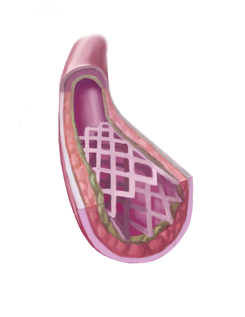 Clogged Artery Stent,illustration