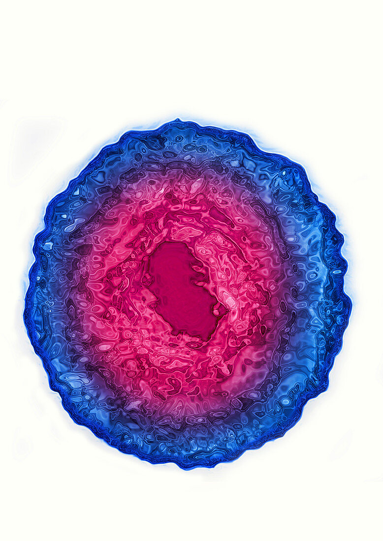 Cytomegalovirus (CMV - HSV5)