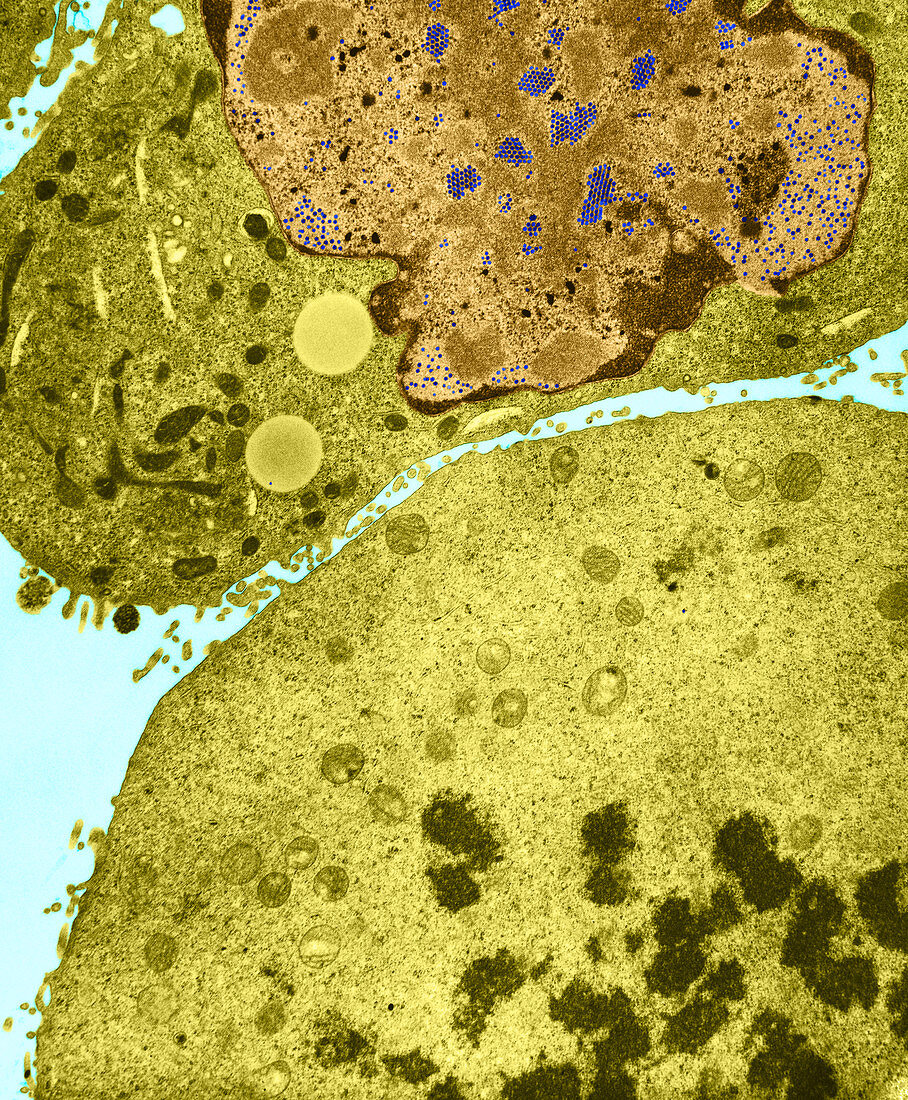 KB Cell Infected with Adenovirus (TEM)