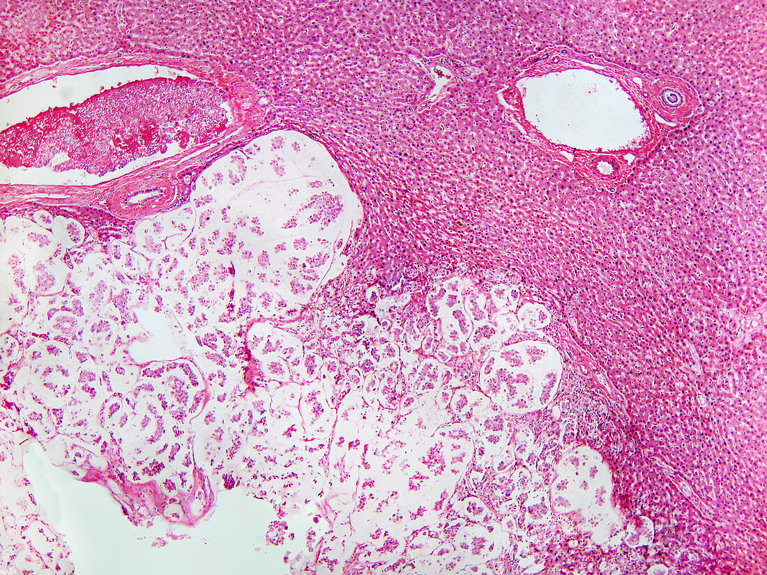 Colloid Liver Tumour,LM